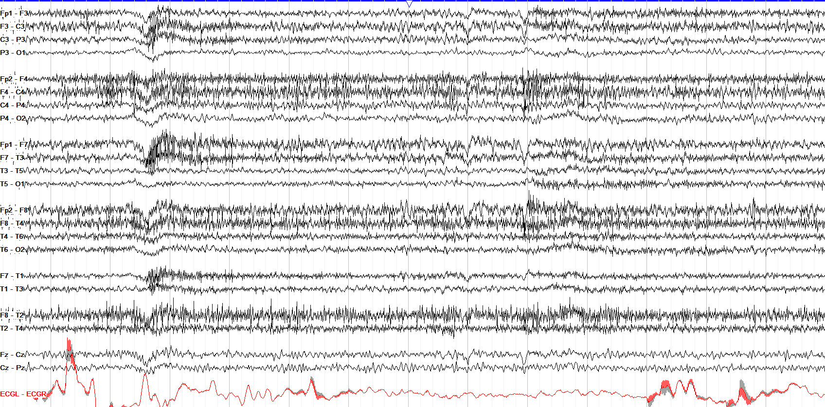 Slowing and other Non Epileptiform Abnormalities